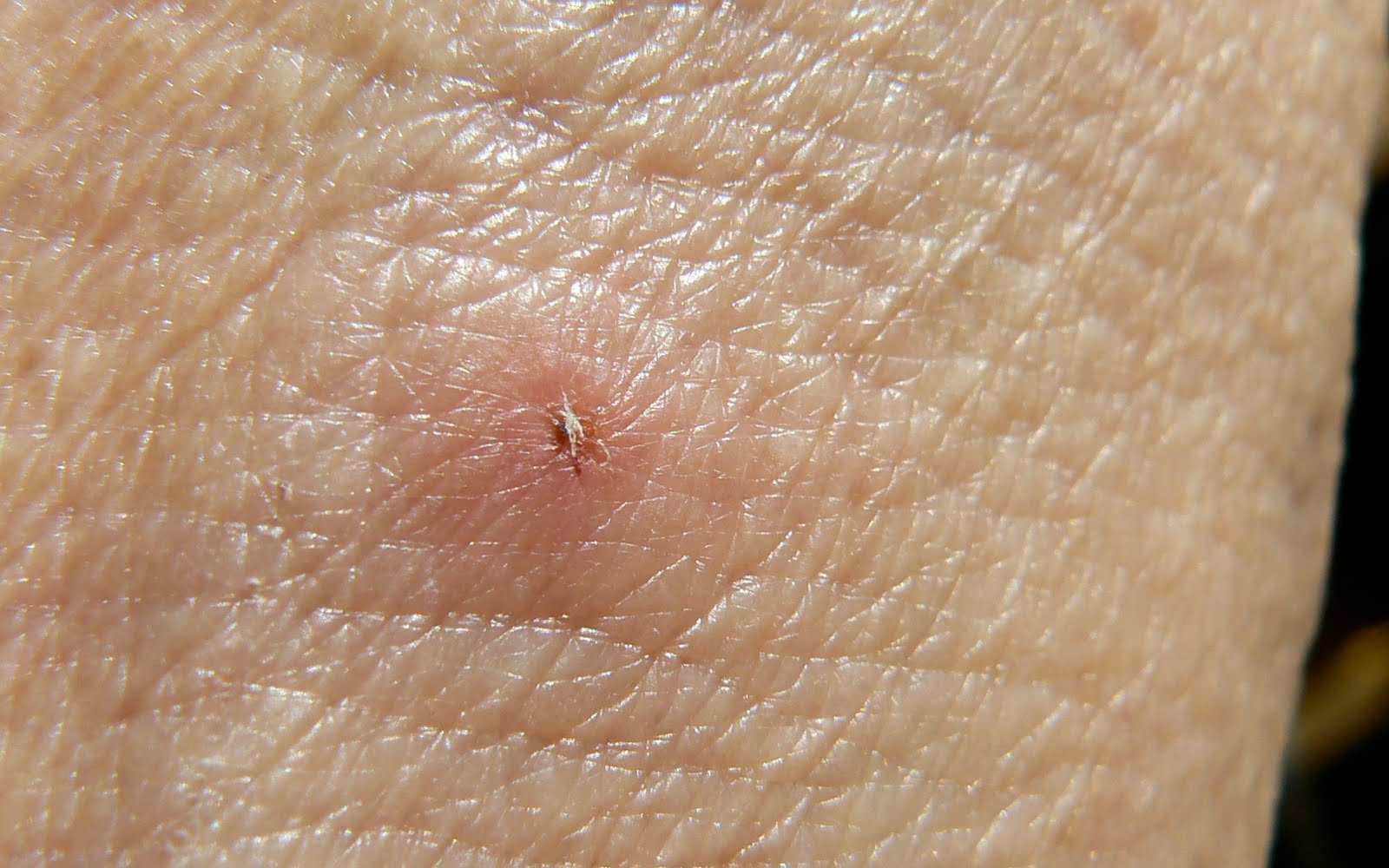 How do you remove a tick from a human body?